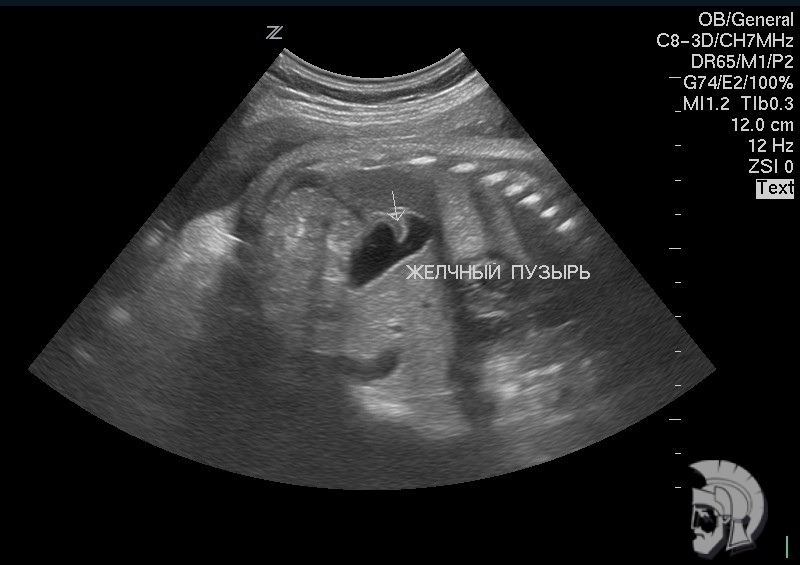 Аномалия развития желчного пузыря плода мужского пола 32 недель Аномалия развития желчного пузыря плода мужского пола 32 недель