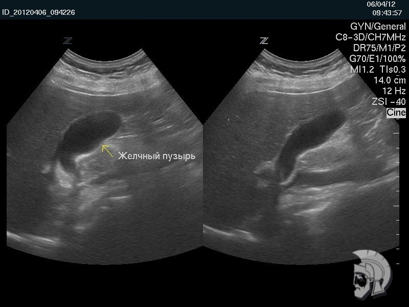 Исследование функциональной активности желчного пузыря Исследование функциональной активности желчного пузыря