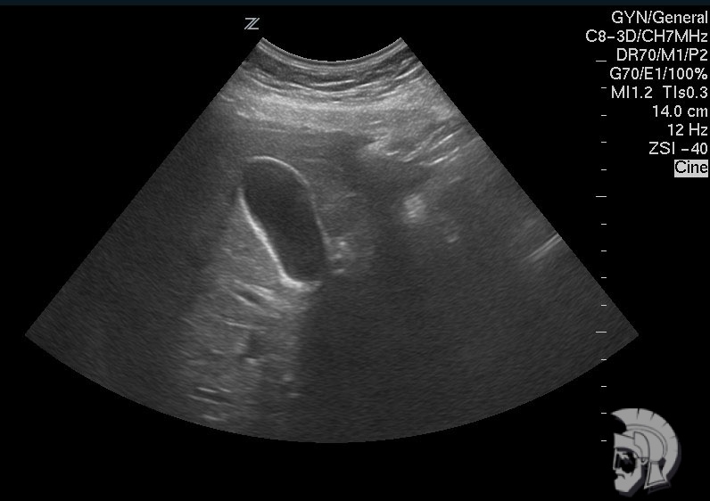Крупный \(переполненный желчью\) желчный пузырь мужчины 40 лет с дискенизией желчевыводящих путей по гипотоническому типу Крупный (переполненный желчью) желчный пузырь мужчины 40 лет с дискенизией желчевыводящих путей по гипотоническому типу