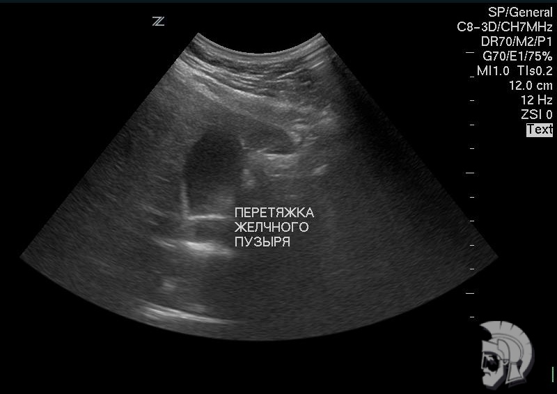 Желчный пузырь с перетяжкой Желчный пузырь с перетяжкой