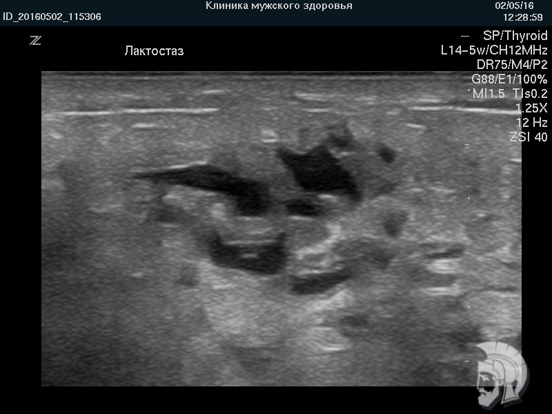 узи груди фото лактостаз