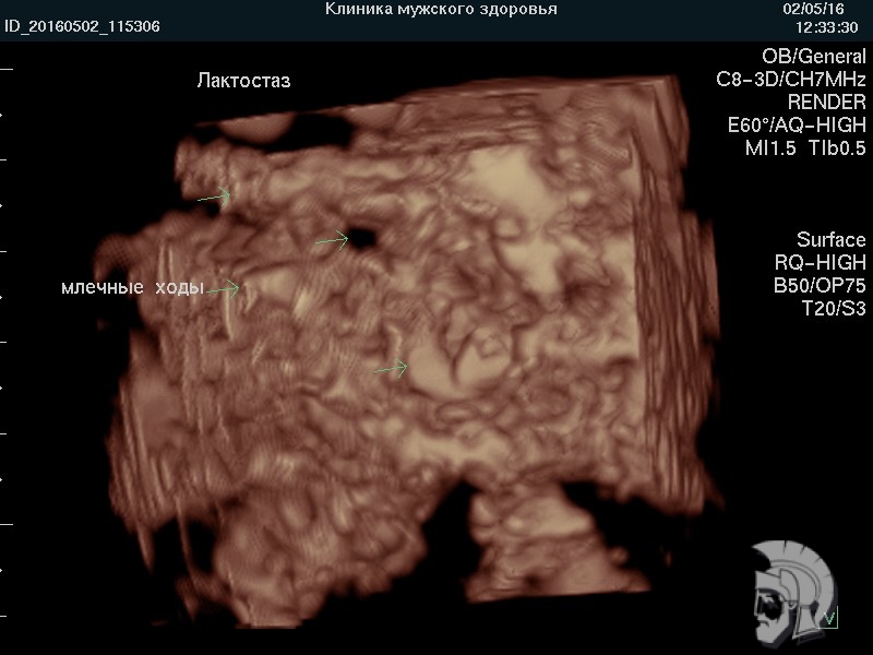 узи груди фото 3D