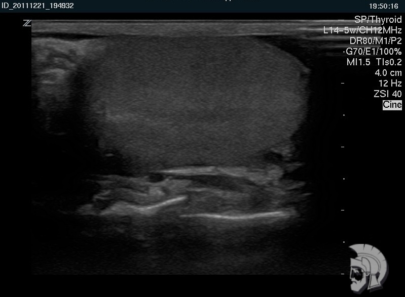 Нормальная эхо-структура яичка Нормальная эхо-структура яичка