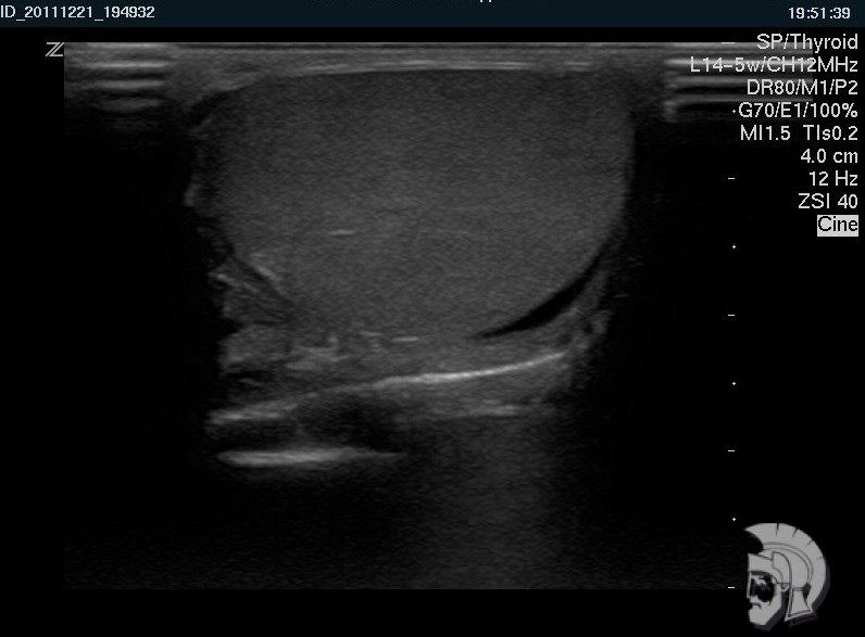 Нормальная эхо-структура яичка Нормальная эхо-структура яичка