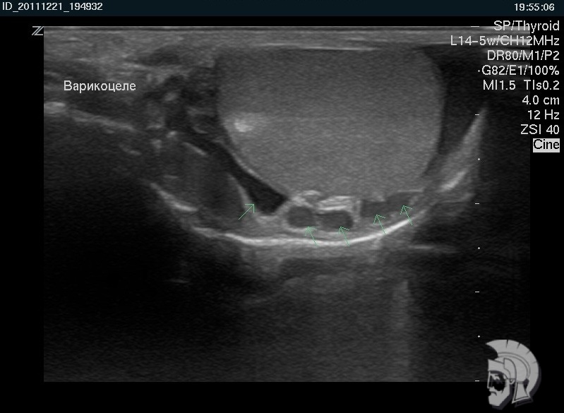 варикоцеле варикоцеле