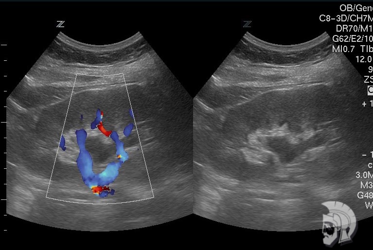 Пиелоэктазия \/расширение почечной лоханки\/ левой почки у подростка 16 лет Пиелоэктазия /расширение почечной лоханки/ левой почки у подростка 16 лет