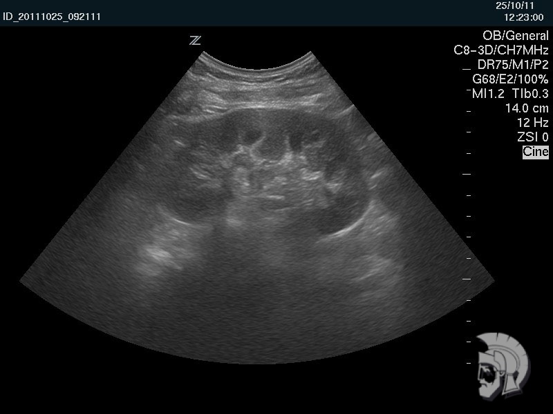Правая почка мужчины 39 лет с хроническим пиелонефритом и стажем заболевания 10 лет Правая почка мужчины 39 лет с хроническим пиелонефритом и стажем заболевания 10 лет