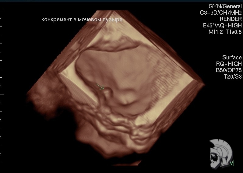 Конкремент 4.5 мм в диаметре \(камень\) Конкремент 4.5 мм в диаметре (камень)