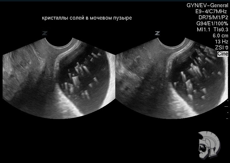 Кристалы солей в мочевом пузыре Кристалы солей в мочевом пузыре