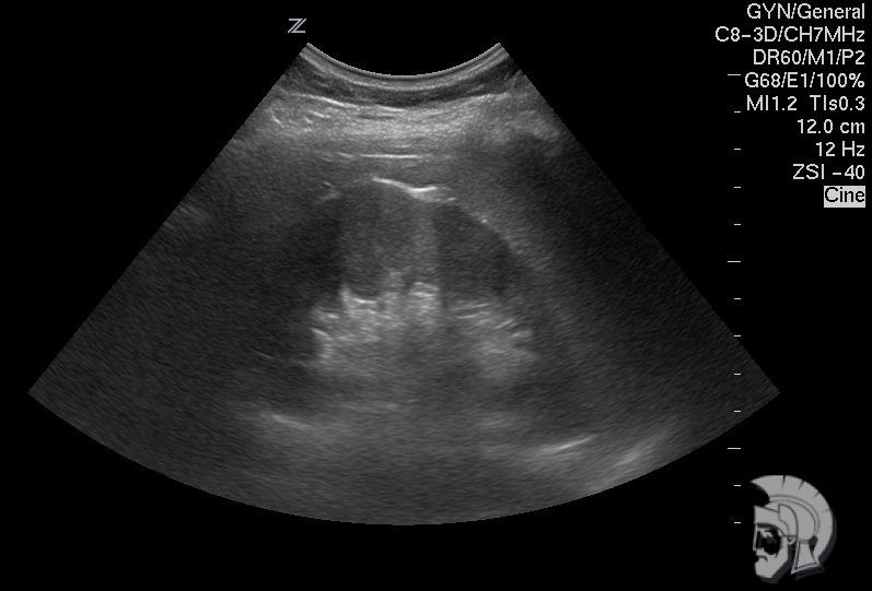 Эхо - структура здоровой почки мужчины 35 лет Эхо - структура здоровой почки мужчины 35 лет