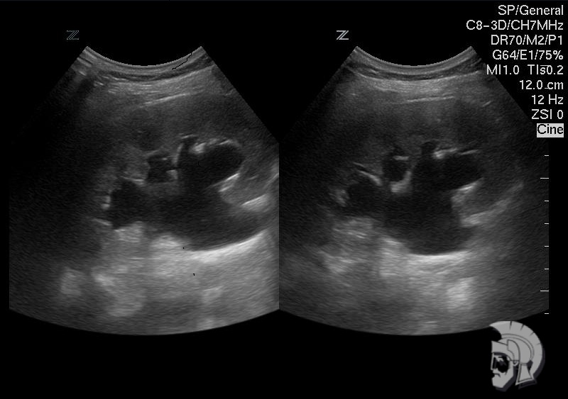 Пиелоэктазия. Расширение чашечно-лоханочной системы левой почки беременной в сроке 24 недели Пиелоэктазия. Расширение чашечно-лоханочной системы левой почки беременной в сроке 24 недели