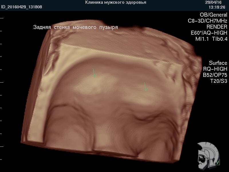3D-фото мочевого пузыря. Определяется складчатость стенок мочевого пузыря. Матка и левый яичник указаны стрелками