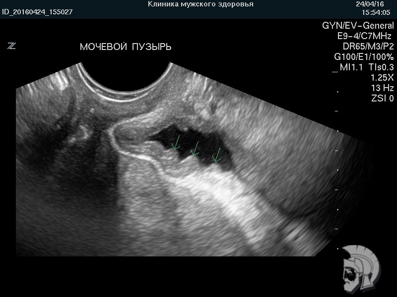 Фото мочевого пузыря нетугого наполнения. Складки слизистой оболочки мочевого пузыря Фото мочевого пузыря нетугого наполнения. Складки слизистой оболочки мочевого пузыря