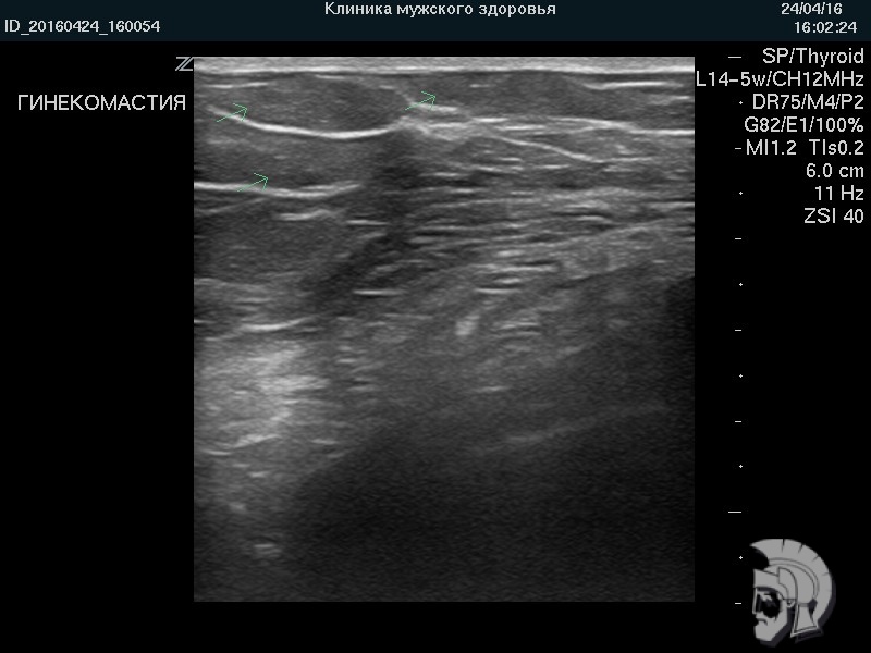 Фото гинекомастии. На фоне мышц \(представлены длинными продольными волокнами\) определяются крупные жировые дольки \(указаны стрелками\) Фото гинекомастии. На фоне мышц (представлены длинными продольными волокнами) определяются крупные жировые дольки (указаны стрелками)